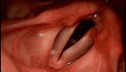 Videos de Cirugias de Laringe 1. Videoestroboscopía diagnóstica Esbozos nodulares – Dr. Mauricio Chalup  2. Videoestroboscopía Diagnóstica Sulcus vocalis pequeño de cuerda vocal derecha –...