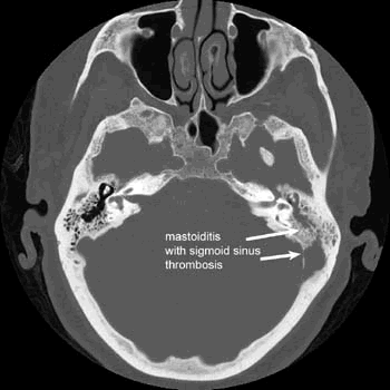 Otitis Externa Medication: Antibiotics, Otic, Other, Oral ...