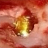 FMT en contacto con crura anterior de estribo