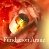 FMT en Ventana Oval + Prótesis en Platinostomia