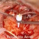 FMT en Ventana Oval + Prótesis Arauz
