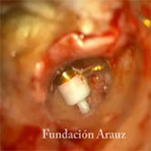 Fibrosis en VO con Protesis Arauz