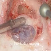1018 - Colesteatoma de Conducto Auditivo Externo y Fosa Posterior