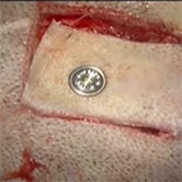 Audífono Implantable - BAHA