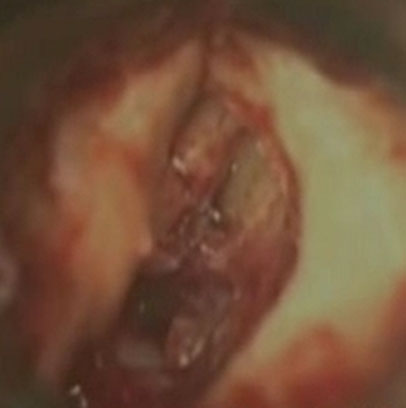 5080 Granuloma externo post EV
