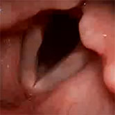 Sulcus vocalis pequeño de cuerda vocal derecha