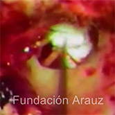 Trabajo en Temporales-Dr S L Arauz-Timpanoplastias Dr S A Arauz-Mayo 1979-Tucuman - Mayo 1979